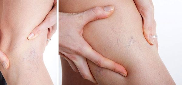 Primo stadio delle vene varicose con rete di vasi visibili